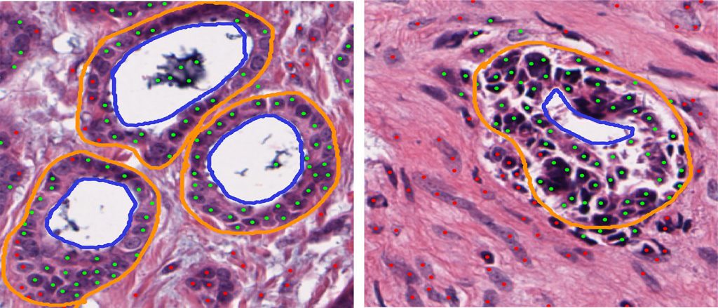 Digitized images shows an aggresive ER+ breast cancer has a high number of tubules being formed and a less aggressive cancer has significantly fewer.