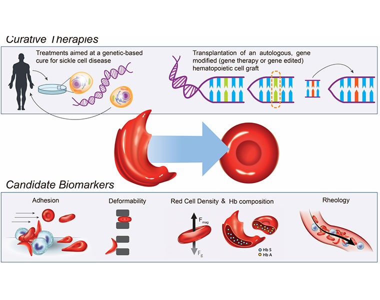 Reaching toward a cure for sickle cell disease Mirage News